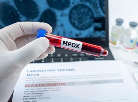 ABD’de Mpox’un yeni varyantından ilk vaka bildirildi