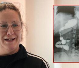 Doktorlar neye uğradığını şaşırdı! Zayıflamak için ameliyata giren hastanın midesini yerinde göremediler