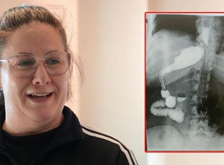 Doktorlar neye uğradığını şaşırdı! Zayıflamak için ameliyata giren hastanın midesini yerinde göremediler