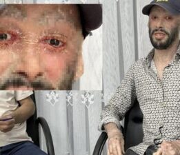 Tedavisi 3 ay sürdü! Hakkarili iktiyozis hastası Refik’ten haber var