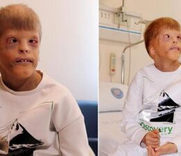 Gözleri kurtarılan Myhailo’ya şimdi kulak kepçesi yapılacak