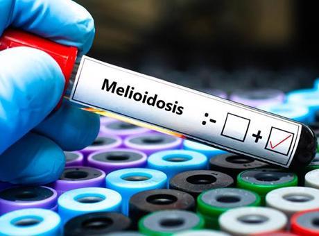 Avustralya’da melioidoz salgını! Can kaybı 31’e çıktı