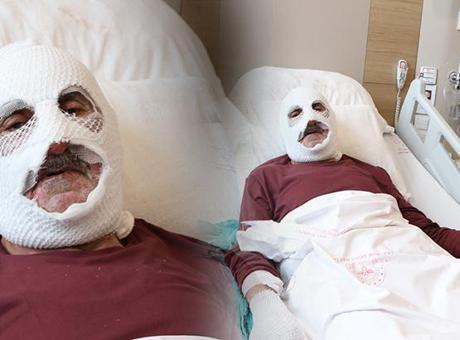 Gaz kaçağını çakmakla kontrol etti, bu hale geldi: O durumda hiç acı hissetmiyordum