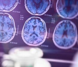 SAĞLIK HABERLERİ: ALZHEIMER HASTALIĞINI ERKEN TEŞHİS EDEN KAN TESTİ