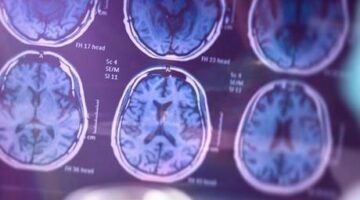 SAĞLIK HABERLERİ: ALZHEIMER HASTALIĞINI ERKEN TEŞHİS EDEN KAN TESTİ