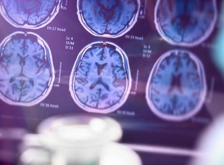 SAĞLIK HABERLERİ: ALZHEIMER HASTALIĞINI ERKEN TEŞHİS EDEN KAN TESTİ