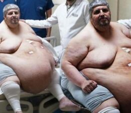 310 kiloya ulaştı! “Ölmek için dua ettim” dedi, yıllar sonra ilk adım
