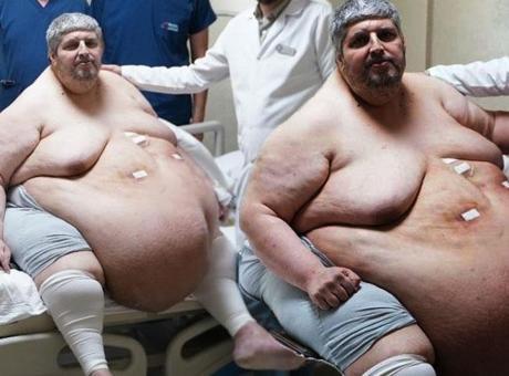 310 kiloya ulaştı! “Ölmek için dua ettim” dedi, yıllar sonra ilk adım