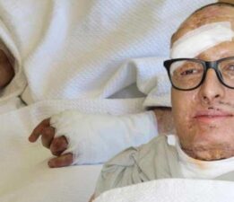 6 bin voltluk akıma kapıldı! Ölümden dönen genç mühendis Türkiye’de şifa buldu