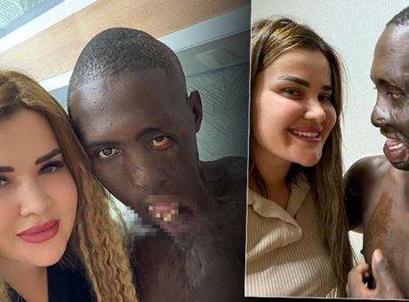 Dudağı omzuna yapışık halde Türkiye’ye geldi! Değişimi dünyaya umut oldu