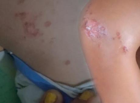Serinlemek için girdi, yanıkla çıktı! Denizde enfeksiyon paniği: ‘Buradan vücuda giriyor’