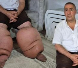 15 yıldır fil hastalığıyla mücadele ediyor: ‘Eşim sadece rahat bir ayakkabı giysin’