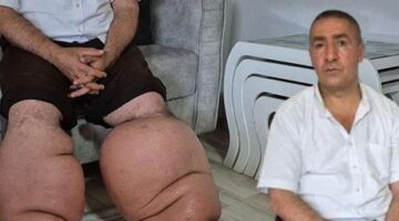 15 yıldır fil hastalığıyla mücadele ediyor: ‘Eşim sadece rahat bir ayakkabı giysin’
