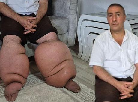 15 yıldır fil hastalığıyla mücadele ediyor: ‘Eşim sadece rahat bir ayakkabı giysin’