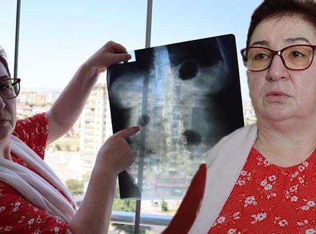 Her şey 6 yıl önce gittiği hastanede ortaya çıktı: 22 yıldır karnında: ‘Canlı bomba gibi geziyorum’