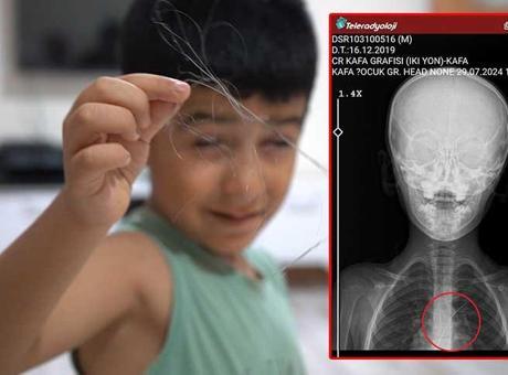 6 yaşındaki çocuk salatalık yuttu şok gerçek ortaya çıktı! ‘1 ay yoğun bakımda kaldı’