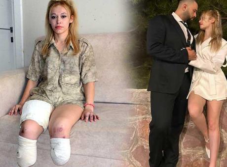 Fitness eğitmeni en mutlu gününde 2 bacağını kaybetti! ‘Evlilik yıl dönümüm cehenneme döndü’